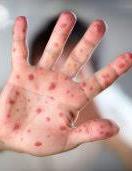 Спалах кору в Україні: рекомендації МОЗ, як запобігти захворюванню (інфографіка)