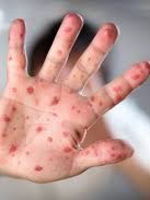 Росія посилила контроль на кордоні через кір